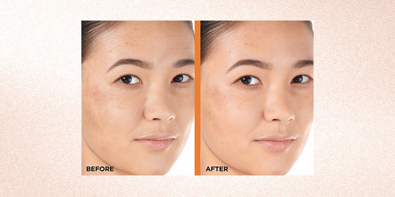 InArticlecloggedporesRevitaLift 12 Pure Vitamin C E Salicylic Acid Serum